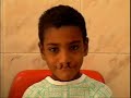 Operation smile in qena