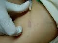 varizes varices escleroterapia varizes varices escleroterapia