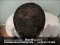 Hair Loss Treatment Video Diary - Comparison Day 1 to Day 88 Hair Loss Treatment Video Diary - Comparison Day 1 to Day 88