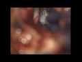 Neuralgia of Trigeminal Nerve - Microvascular Decompression Surgery Neuralgia of Trigeminal Nerve - Microvascular Decompression Surgery