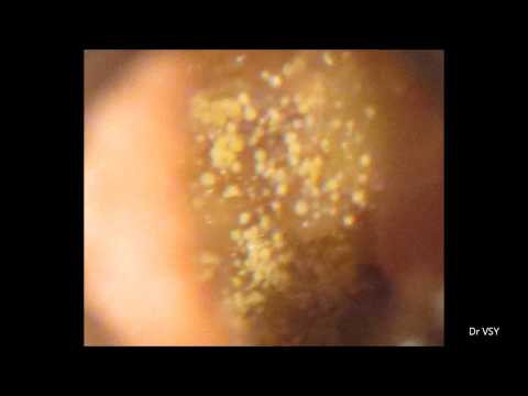 how to remove ear fungus