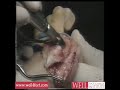 1st MPJ Implant for Hallux Rigidus 1st MPJ Implant for Hallux Rigidus