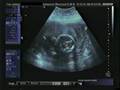 Ultrasound - 20 Weeks - Baby Boy