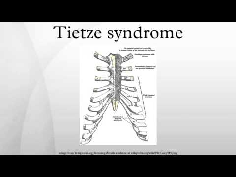 how to treat tietze syndrome