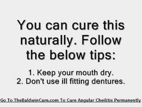 how to treat glossitis