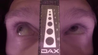 DAX™ Field Video 002 - Duane Syndrome 