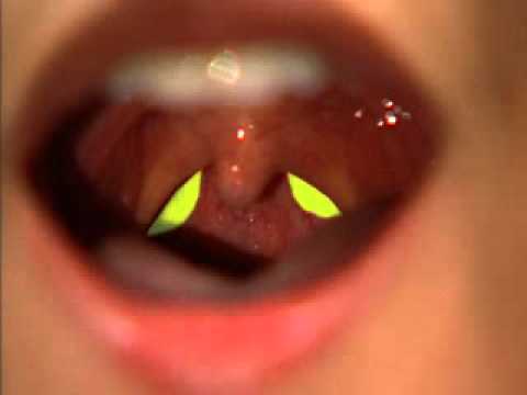 how to assess gag reflex