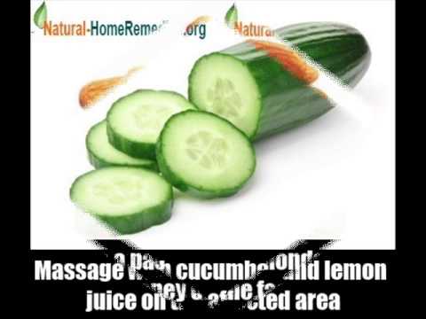 how to cure melasma