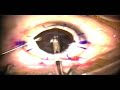 Triple Procedure (Deep Lamellar Keratoplasty + Phaco) Triple Procedure (Deep Lamellar Keratoplasty + Phaco)