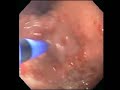Gastric Antral Vascular Ectasia Gastric Antral Vascular Ectasia