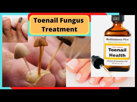 how to kill foot fungus naturally