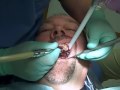 dental filling 3