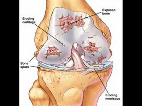 how to control joint pain
