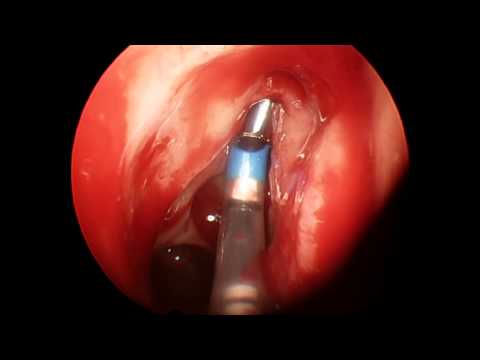 how to relieve frontal sinus pressure