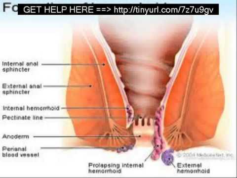 how to avoid hemorrhoids
