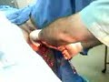 Parto normal Dr Derat GyO IMSS Navolato Sinaloa Parto normal Dr Derat GyO IMSS Navolato Sinaloa