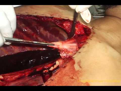 embalming -