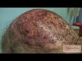 Body Hair Transplantation ( BHT ) by Dr Sanusi Umar