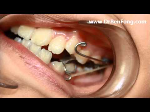 how to fix underbite