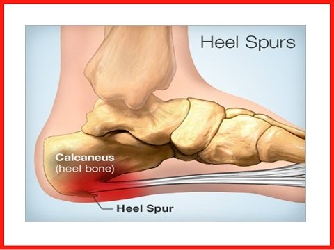 how to cure heel pain