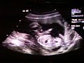 16w6 day u/s 16w6 day u/s