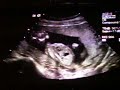 16w6 day u/s