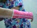The cast removal!!!!