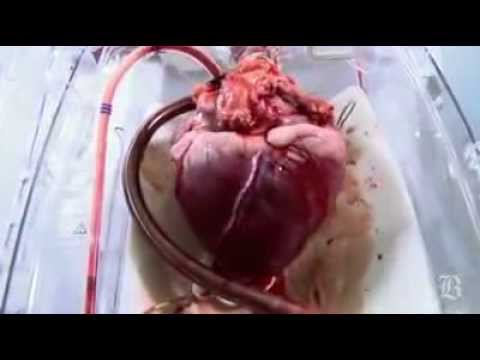 how to transplant a heart