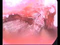 Laparoscopic sacrocolpopexy for uterine prolaps