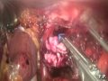 Prof. Francesco puglisi policlinico bari trattamento gist esofageo per via laparoscopica