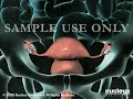 3D Medical Animation: Hysterectomy (Removal of the Uterus) Surgery