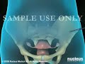3D Medical Animation: Hysterectomy (Removal of the Uterus) Surgery