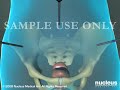 3D Medical Animation: Hysterectomy (Removal of the Uterus) Surgery