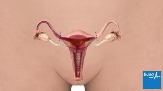 How abdominal hysterectomy is carried out