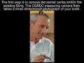 Cerec single visit restorations