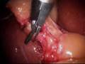 Jim's Gall Bladder
