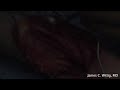Distal Humerus Giant Cell Tumor Resection - Part 1