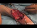 Excision Of Distal End Of Humerus Due To Giant Cell Tumor - 1/6