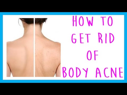 FAQ: How to Get Rid of Body Acne, (Back acne, chest acne, leg acne, arm acne)