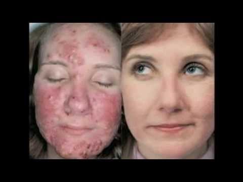 how to get rid of p acne