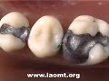 Smoking Teeth = Poison Gas Smoking Teeth = Poison Gas