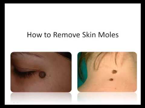 how to eliminate skin moles