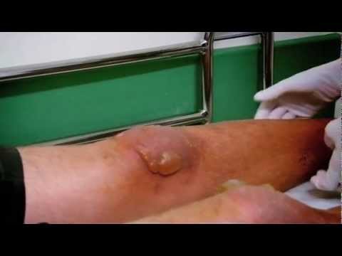 how to treat burn blisters