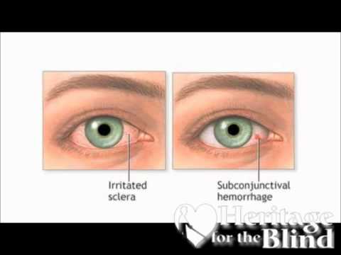 how to relieve runny eyes