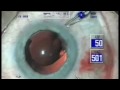 IOL Implantation
