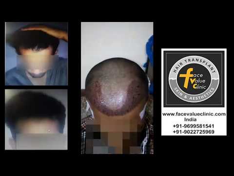 Before and After Hair Transplant Surgery | Face Value Clinic, Mumbai, IN_Plastic surgery, liposuction brand new videos.