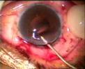 Intracapsular cryo extraction and Artisan Lens implant