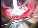 Glaucoma Surgery