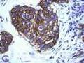 Breast Cancer Pathology