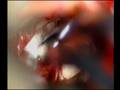Trigeminal Neuralgia Surgery Video with commentary